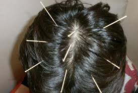 Seven Star Acupuncture Needle Can Heal Hair Loss