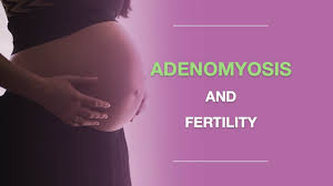 Unlike a hysterectomy, which takes out your entire. Adenomyosis And Fertility Can You Get Pregnant And What To Expect