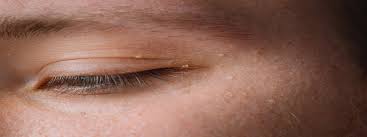 white spots under the eyes causes and