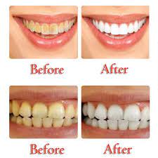 Baking soda manufacturers have not mastered the handy packaging you find among most toothpastes. Baking Soda Teeth Whitening Toothpaste Buy Today Get Up 70 Discount Inspirefind