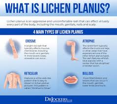 lichen pl symptoms causes and