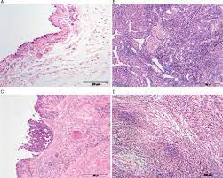 According to the research, the survival odds of mesothelioma decreased by at least 9% for each 1 g/l albumin level reduction. Immunohistochemical Differentiation Of Reactive From Malignant Mesothelium As A Diagnostic Aid In Canine Pericardial Disease Milne 2018 Journal Of Small Animal Practice Wiley Online Library