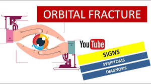 orbital fracture signs symptoms