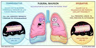 pleural effusions transudate vs