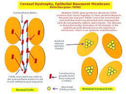 Corneal Dystrophy Epithelial Basement