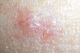 red spots on skin top 19 causes with