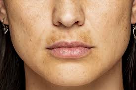 how to get rid of a melasma mustache