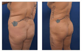 ideal treatment of lipedema surgisculpt