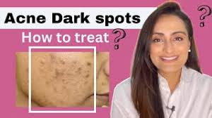 acne dark spots ह द how to