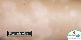 The term is derived from the words pityriasis (scaly) and alba (white). Pityriasis Alba Skin Issue Dermatitis Medicalwale Com