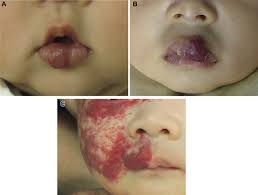 lip infantile hemangiomas involving the