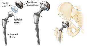 hip replacement gormack orthopaedics