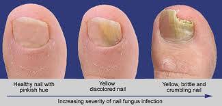 fungal toenails ociate foot