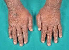 swollen hands and feet syndrome the bmj