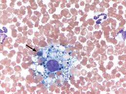 And, how it coincides with the rare cancer known as mesothelioma. Effusion Cytology Clinician S Brief