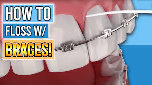 Flossing should be done after brushing How To Floss With Braces Premier Orthodontics