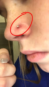 Formation of bumps and abscess is also a common sign of infected nose piercing. Infected Nose Piercing Glow Community
