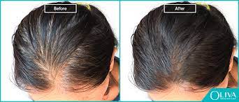 thyroid disorder hair loss how to
