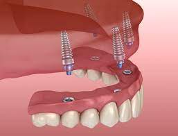 how many teeth can dental implants replace