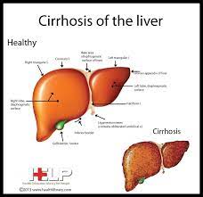 Cirrhosis is defined histologically as a diffuse hepatic process characterized by fibrosis and the conversion of normal liver architecture into structurally abnormal nodules. 10 Liver Cirrhosis Ideas Cirrhosis Liver Liver Disease