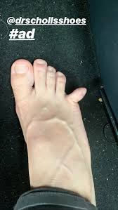 My pinkie toe on my left foot is very tender,it's red and the nail looks black , i did not bang it into any objects, and it is painful to walk what 's going on? This Dude S Broken Toe Is So Gross But His Wife Made It Hilarious Health Com
