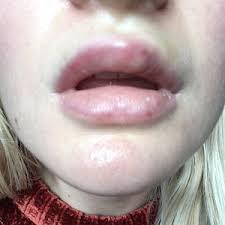 top lip following lip filler