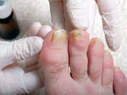 thick toenails causes symptoms and