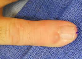 disorders of the nail orthopaedia