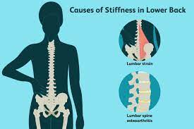 causes and treatment of low back stiffness