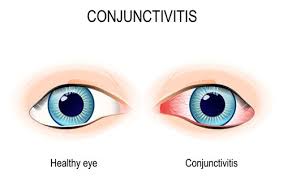 conjunctivitis pink eye causes and