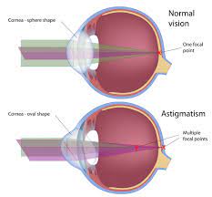 can lasik surgery fix astigmatism