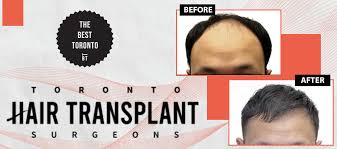 clinics with the best hair transplants
