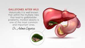 gallstones after wls causes symptoms