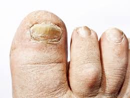 what causes toenail ridges with pictures