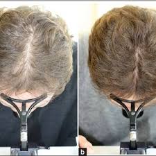This allows the proper nutrients and oxygen levels to reach the scalp and support a healthy head of hair. Use Of Low Level Laser Therapy As Monotherapy Or Concomitant Therapy For Male And Female Androgenetic Alopecia Request Pdf