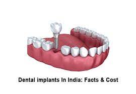 cost of full mouth dental implant in