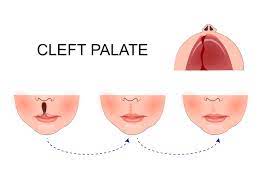 cleft palate and cleft lip a complete