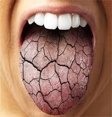 dry mouth symptoms causes treatment
