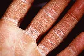 جفاف الجلد: الأسباب والأعراض والتشخيص والعلاج - أنا أصدق العلم
