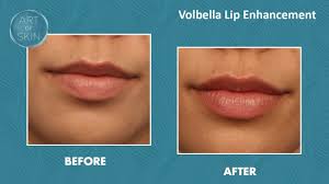 volbella lip enhancement to vermillion