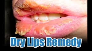 dry lips home remedy