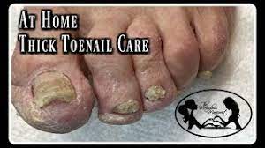 thick toenails and nail fungus
