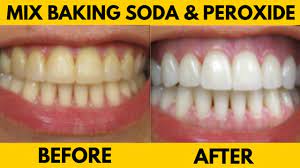 baking soda and hydrogen peroxide teeth