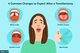 what to expect after a tonsillectomy