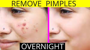 how to remove pimples overnight acne