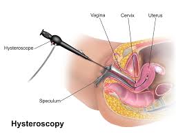 hysteroscopy melbourne surgery