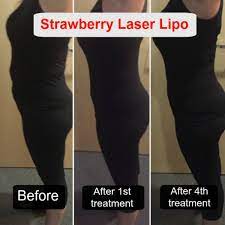 strawberry laser liposuction does it