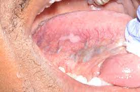The grade describes the appearance of the cancerous cells. Self Oral Cancer Screening Socs Education Program School Of Dentistry Lsu Health New Orleans