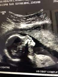 cleft in 20 week ultrasound babycenter