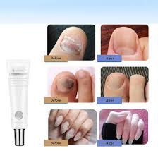 toenail fungus treatment cream nail
